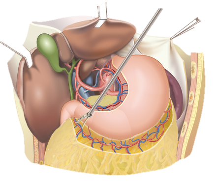 前研 | 外科止血超聲刀類產品臨床及注冊